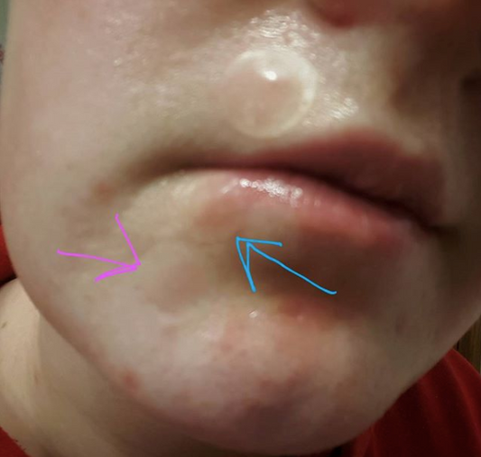Pimple Patch Battle