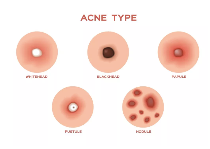 Acne - The Basics